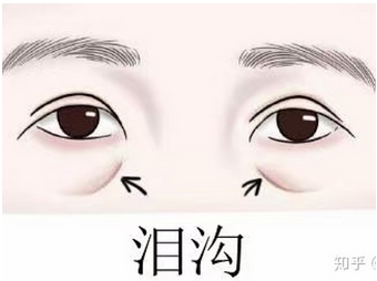 济南泪沟填充哪里做的好?泪沟填充果怎么样?魅力双眼靠它了!