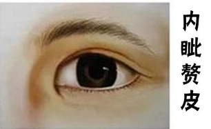 吴包金双眼皮价格怎么样？医生简介！人气怎么样！案例反馈get~