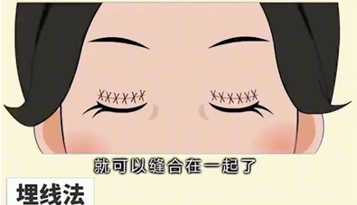 全切双眼皮能维持几年？手术有哪些禁忌人群？附正规眼部整形医美测评~