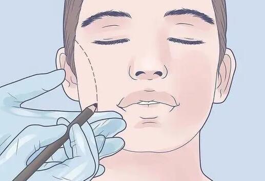 酒窝整形术怎么做?要多少钱?满分女孩速成指南get上!附注意事项~