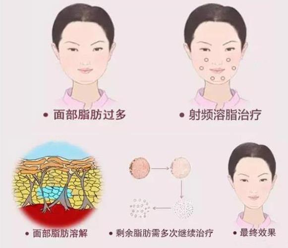 光纤溶脂瘦脸需要戴多久头套?危害、注意事项总结在这里~