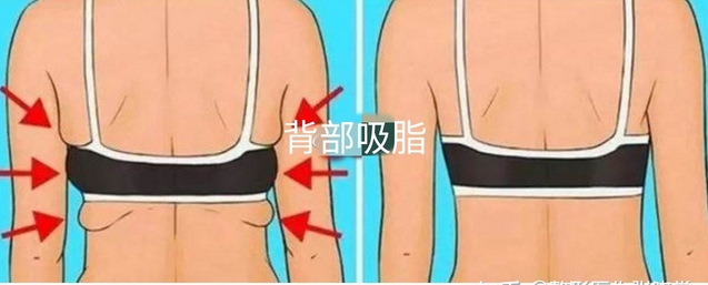 背部吸脂有果吗?手术过程是怎么样的？附注意事项~