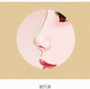 朝天鼻整形案例公布！网友亲身经历分享！术后鼻子弧度很流畅~