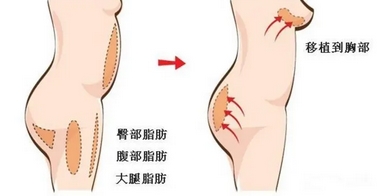 自体脂肪隆胸是终身吗？术后多久可以恢复？手术有哪些禁忌人群？