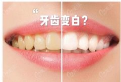 冷光美白牙齿可以白到啥程度？手术过程中有哪些注意事项呢？冷光美白牙齿的步骤详解~