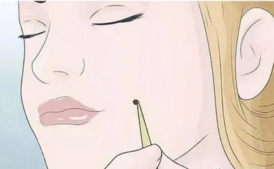吴包金切痣案例怎么样？术后日记曝光！看看术后果是否理想？