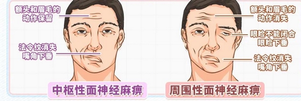 面瘫后遗症能吗？面瘫是什么原因引起的？面瘫多久可以恢复呢？