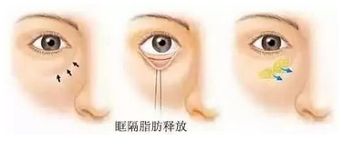 内切眼袋填充泪沟手术后遗症有哪些？手术原理科普！手术要多久恢复？