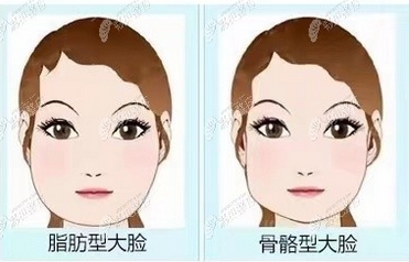 脸一边大一边小怎么纠正？磨骨手术的风险大吗？价格低-恢复期长吗？