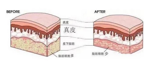 一次抽吸过多脂肪会怎么样？吸脂减肥会反弹吗？抽取方式_价格如何？ 