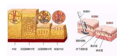 一次抽吸过多脂肪会怎么样？吸脂减肥会反弹吗？抽取方式_价格如何？ 