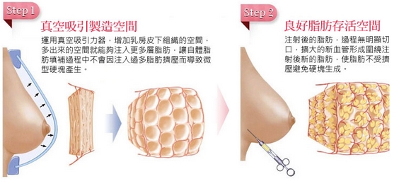 自体脂丰胸是不是永久性的？价格怎么样？担心会有副作用~