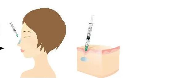 鼻子注射玻尿酸多少钱?效果如何?术前必看的注意事项~