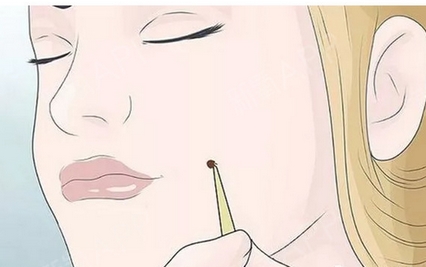 专业去痣是什么样的？激光祛痣多少钱一颗？多久可以碰水呢？ 