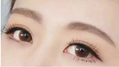 张恒术双眼皮案例公布！手术前后真实案例分享！甩掉双眼皮贴~ 
