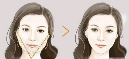 脸部抽脂后会反弹吗？优势和弊端一并列举！手术后需要注意什么？ 