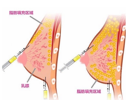 自体脂肪隆胸两年后的忠告！自体脂肪隆胸的适应症有哪些？需要多久恢复？ 