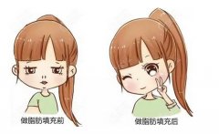 脂肪填充鼻子变宽怎么办？术前术后注意事项-脂肪填充案例欣赏！ 