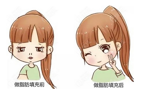 脂肪填充鼻子变宽怎么办？术前术后注意事项-脂肪填充案例欣赏！ 