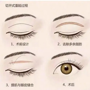 张冰洁修复双眼皮好不？医生信息_双眼皮整形案例公布！附医院详情~ 