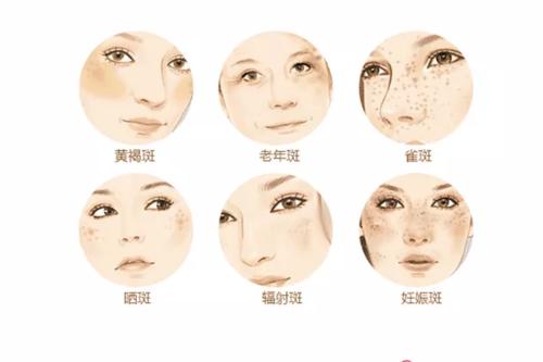 黄褐斑调节费用是多少？价格影响因素、黄褐斑形成原因盘点！