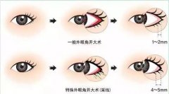 开内眼角后遗症是什么？感染、留疤、不对称等！可以避免~