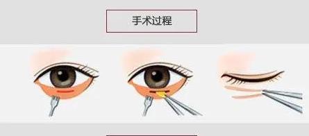 割眼袋要多少钱？有哪些方式？眼周抗衰须知指南~