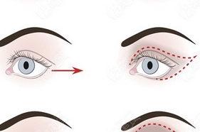 张冰洁眼综合案例怎么样？值得为你推荐技术优势！附真实案例~  