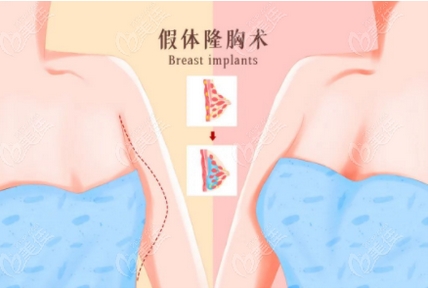 自体脂肪隆胸和假体隆胸哪个好？优缺点需注意~做胸之前必看的知识点！ 