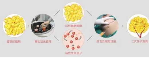 自体脂肪隆胸可以保持多少年？不同注射手法不同果！带你了解~ 