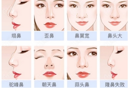 朝天鼻整形美容哪家医院做得好？排行榜前五实力盘点！“塌鼻星人”有救了~ 