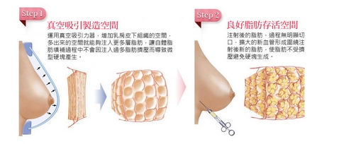 自体脂肪隆胸恢复期要多久？天生胸小、产后垂下这些都不是问题！术前需要注意什么？ 