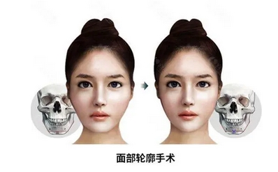 磨颧骨会下垂吗？术后应该怎样去护理呢？附手术原理~ 