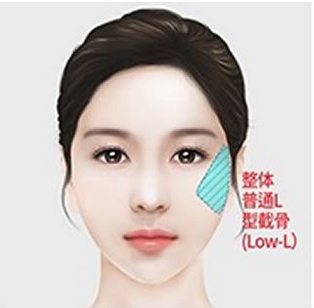 磨颧骨会下垂吗？术后应该怎样去护理呢？附手术原理~ 
