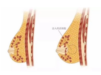 自体脂隆胸手术有副作用吗？感染、外形差、脂肪液化这些问题都可以避免吗？ 