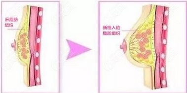 自体脂隆胸手术有副作用吗？感染、外形差、脂肪液化这些问题都可以避免吗？ 