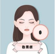 去痣会留疤吗？去痣后怎样避免留疤？带你揭秘原理、危害！ 