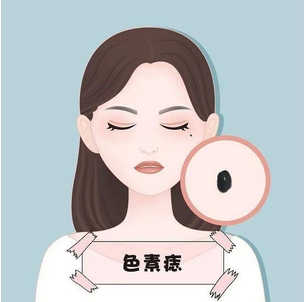 去痣会留疤吗？去痣后怎样避免留疤？带你揭秘原理、危害！ 