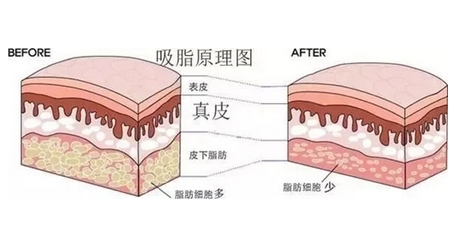 背部吸脂的危害有哪些？术后护理方法分享，美体攻略必看！ 