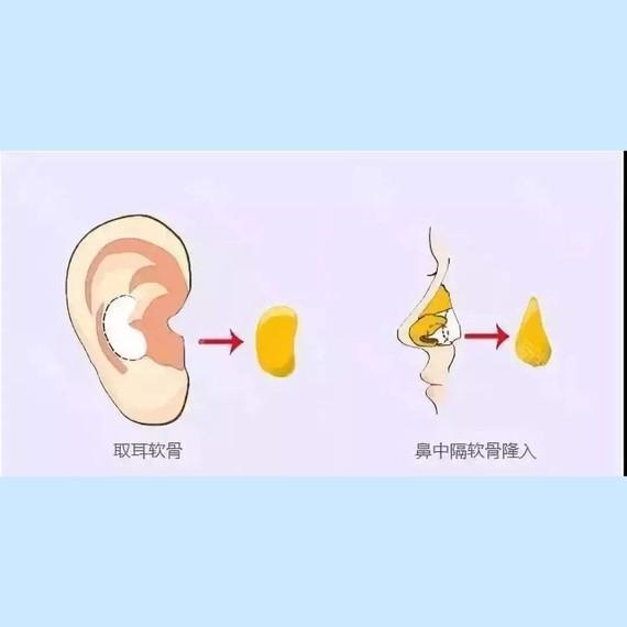 隆鼻哪种材料好一点？软骨-硅胶-膨体等，各自优势介绍！