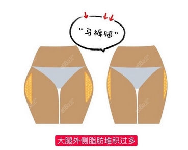 腹部吸脂需要多少钱？吸脂后容易反弹吗？费用是怎么构成的？