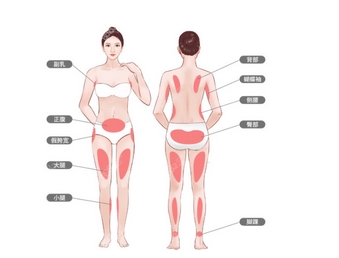 腹部吸脂需要多少钱？吸脂后容易反弹吗？费用是怎么构成的？
