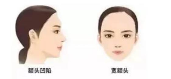 额头窄丰额头要多少钱?用的什么材料比较好?注意事项有哪些