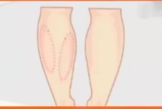 光纤溶脂瘦小腿好吗？做完吸脂手术以后需要注意什么？