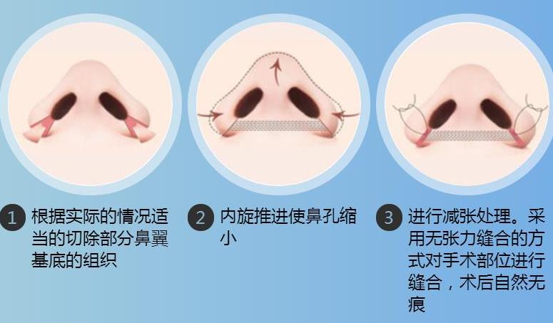 鼻头缩小手术的价格是多少？收费标准_术后注意事项抢先看！