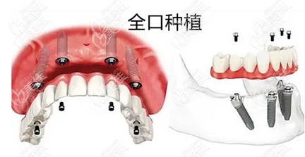 4000元的种植牙可靠吗？太便宜种植牙齿会不会有什么风险呢？附注意事项~