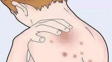 玫瑰糠疹是什么？有什么症状呢？发作时需要做些什么？ 