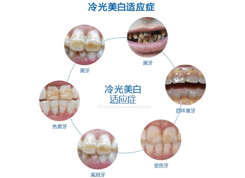 怎么能美白牙齿？去渍好的几种方法介绍！