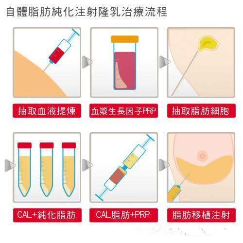 广州军美王世虎医生怎么样？技术、擅长项目介绍！脂肪丰胸案例~