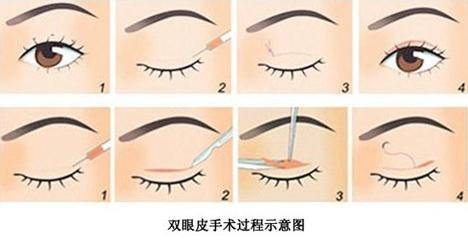 江苏省中医院陈刚双眼皮做的怎么样？专家技术点评_案例图展示！